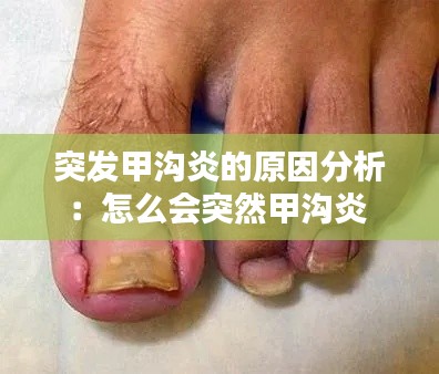 突發(fā)甲溝炎的原因分析：怎么會(huì)突然甲溝炎 