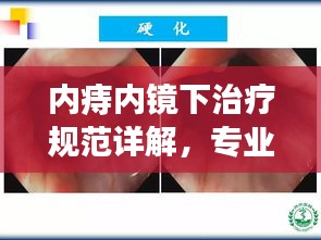 內(nèi)痔內(nèi)鏡下治療規(guī)范詳解，專業(yè)指南引領(lǐng)新篇章！